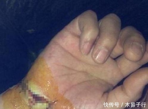 做梦吃猪蹄啃手|一男子做梦吃猪蹄，醒了却赶紧送医院，背后真相让人惊呆了