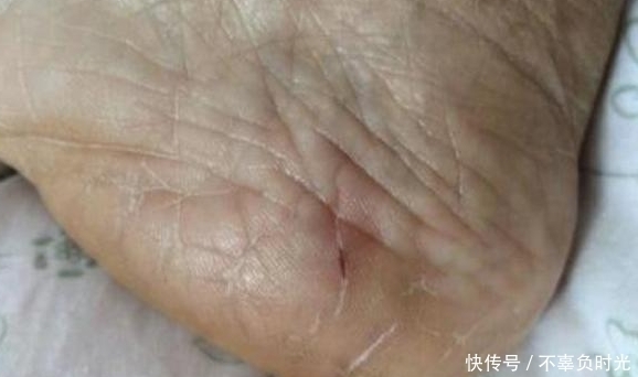 干裂|脚后跟干裂，跟身体健康有关系吗？不要再忽视了