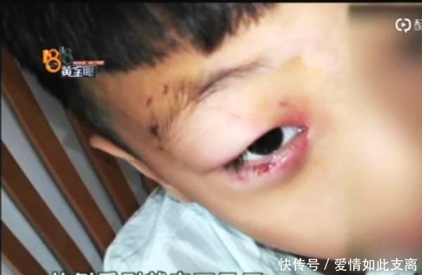  疫苗|为什么男孩被狗咬伤后, 打了三针狂犬病疫苗后, 还会发病身亡?
