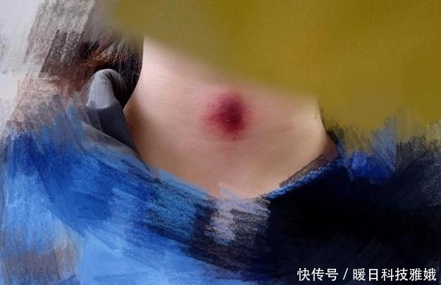 红印|女友脖子上有红印，自称是中暑导致，男子疑为“草莓”找医生验证